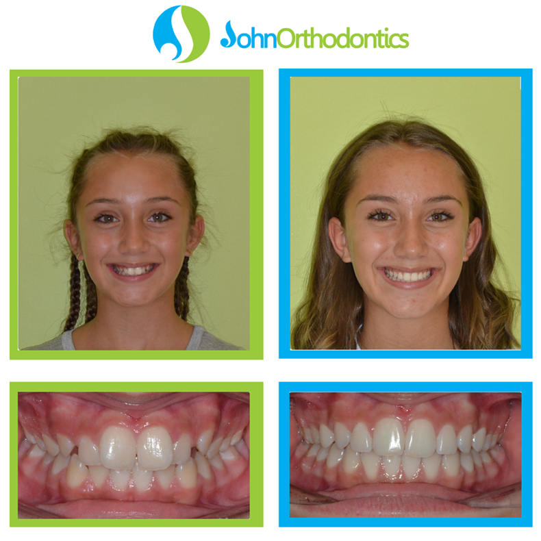 best orthodontist coral springs fl