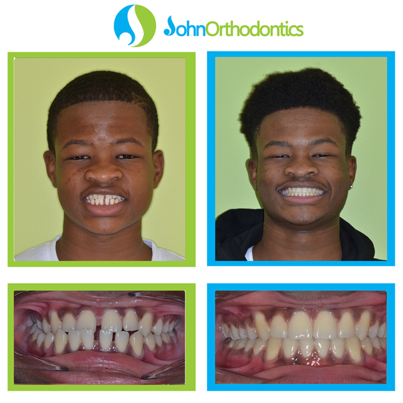 best orthodontist parkland fl