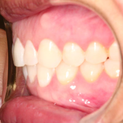 best braces parkland